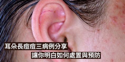 耳朵長痘痘面相|【耳朵長痘痘 面相】耳朵長痘痘發大財？ 財富降臨的證據就在臉。